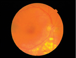 Eyecare Trust - Retina
