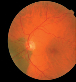 Routine eye examination reveals life-threatening tumour
